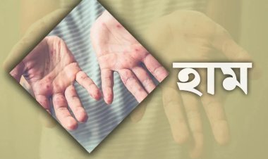২৪ ঘণ্টায় হাম ও উপসর্গে আরও ১২ জনের মৃত্যু