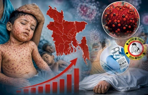 সিলেটে হামের উপসর্গে আরও এক শিশুর মৃত্যু