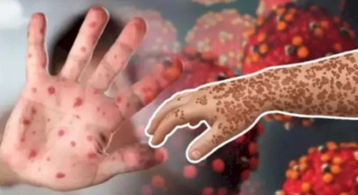 সিলেটে হাম উপসর্গে ১দিনে ৫ শিশুর মৃত্যু